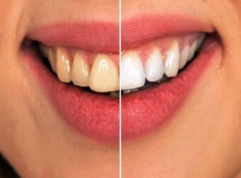 Τερηδόνα: Πώς θα την εξαφανίσετε τελείως και θα αποκτήσετε υγιή και γερά δόντια – Ομορφιά & Υγεία