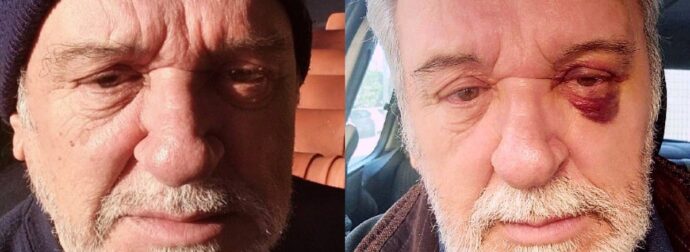 Τάσος Χαλκιάς: Με «μαυρισμένο» μάτι ο ηθοποιός, το μήνυμα όλο νόημα