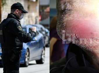 Ηράκλειο: Πήγε να του κάνει έλεγχο και εκείνος τον δάγκωσε στο πρόσωπο – Έκοψε κομμάτι από το πιγούνι του