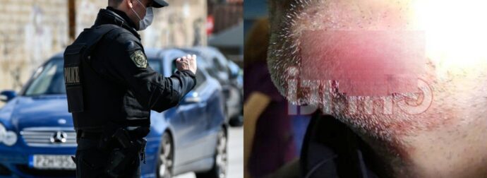 Ηράκλειο: Πήγε να του κάνει έλεγχο και εκείνος τον δάγκωσε στο πρόσωπο – Έκοψε κομμάτι από το πιγούνι του