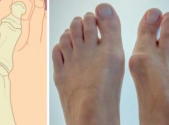 Κότσι στα πόδια: Πώς να το προλάβετε – 3 τρόποι για να το αντιμετωπίσετε – Ομορφιά & Υγεία