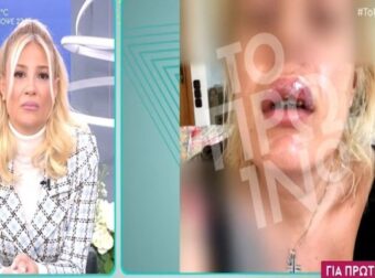 Σοκάρει η 38χρονη που καταγγέλει ότι παραμορφώθηκε από γνωστό πλαστικό χειρουργό: «Έχω κάνει δύο απόπειρες αυτοκτονίας» (Video) – Gossip