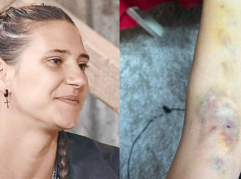 Μαρία Μιχαλοπούλου: Μας δείχνει τα αποτελέσματα στο χέρι της, μετά τη θεραπεία που ξεκίνησε