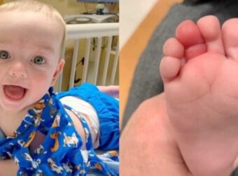 Αδιανόητο: 5 μηνών μωράκι κινδύνευσε από τρίχα να χάσει το δάχτυλο σου – Funny-Περίεργα