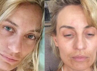 Ελεονώρα Μελέτη: «Τότε που έτρωγα καρότα, είχα τέλεια φουσκωτά χείλη και πυκνά μαλλιά. Άραγε θα το ξαναζήσω;»