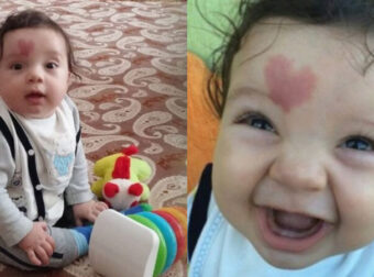 Το μωράκι της αγάπης: Το αγοράκι που γεννήθηκε με ένα σημάδι καρδιάς και το λατρεύει όλος ο κόσμος