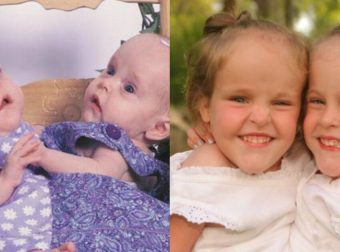 Αληθινή ιστορία: Τα σπάνια σιαμαία δίδυμα που γεννήθηκαν το 2002, σήμερα είναι δυο υπέροχες κοπέλες και έχουν πάρει ξεχωριστούς δρόμους