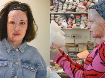 Γιατρός Ιωάννας: «Το έγκαυμά της, το μεγαλύτερο παγκοσμίως. Δεν θα γίνει ποτέ όπως ήταν πριν το βιτριόλι»