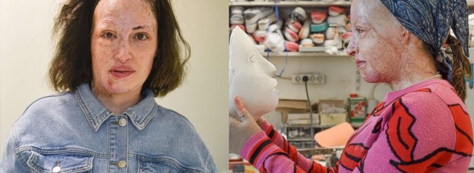 Γιατρός Ιωάννας: «Το έγκαυμά της, το μεγαλύτερο παγκοσμίως. Δεν θα γίνει ποτέ όπως ήταν πριν το βιτριόλι»