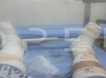 Σουδάν: Φωτογραφία ντοκουμέντο από τα τραύματα του Έλληνα τραυματία – «Ελπίζουμε σε ένα θαύμα» (Video)